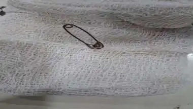 Kota Doctors Successfully Remove Open Safety Pin Lodged Near Child's Brain
